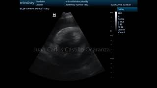 Taponamiento Cardiaco canino pre y post pericardiocéntesis [upl. by Nesta]