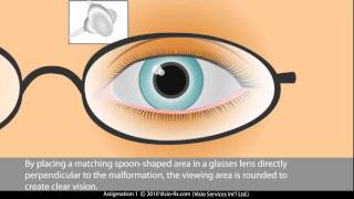 Cylinder in Prescription Glasses Astigmatism Correction [upl. by Nemaj]