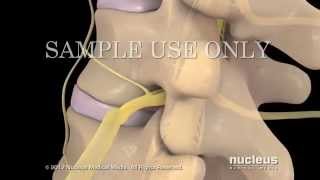 Lesiones de disco lumbar y tratamiento [upl. by Kimble]