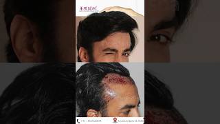 The Best Hair Transplant Results by Dr Suneet Soni at Medispa Hair Transplant Centre FUT  FUE combo [upl. by Dawaj]