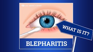 Blepharitis red swollen eyelids Causes Symptoms Treatments [upl. by Saunder]