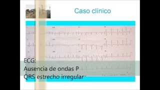 FIBRILACION AURICULAR SNU EL CALERO  GRAN CANARIA [upl. by Assirhc]