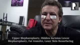 2 Male Blepharoplasty Eyelid Lift Video Diary Four hours after Surgery [upl. by Roanna]