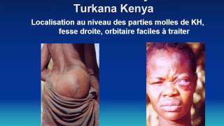 GASTROENTEROLOGIE Le kyste hydatique du foie [upl. by Beedon]