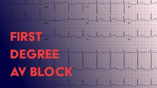 First Degree AV Block  EKG ECG Interpretation [upl. by Paradies185]