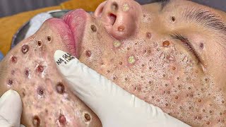 Big Cystic Acne Blackheads Extraction Blackheads amp Milia Whiteheads Removal Pimple Popping  1202 [upl. by Sirmons]