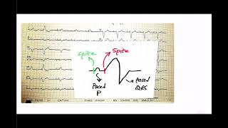 ECG refresher11 [upl. by Matthaeus]