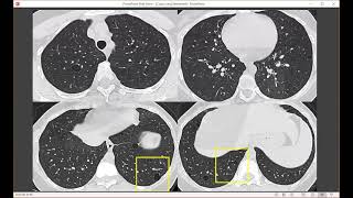 Holy Holes Cystic Lung Disease on HRCT [upl. by Novehc]