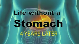 Esophagectomy 4 years later [upl. by Lisbeth]