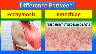 Distinction Between Ecchymosis and Petechiae [upl. by Zadack]