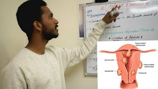 UTERINE FIBROID  SHORT REVIEW  MEDDY SIMPLIFIED  OBG [upl. by Nnayd]