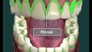 Tooth Decay  How it Happens and How to Avoid it [upl. by Arabelle]