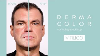 How To Cover Vitiligo With Dermacolor  Kryolan Makeup Tutorial For Flawless Coverage [upl. by Rotberg]