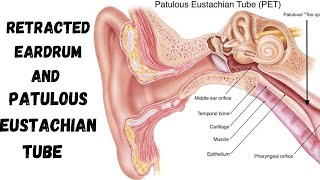 Patulous Eustachian Tube  Retracted Pockets  Eustachian Tube Disorders Last Part [upl. by Gehman]