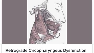 Part 1 of my RCPD journey Retrograde Cricopharyngeus Dysfunction [upl. by Conlan]