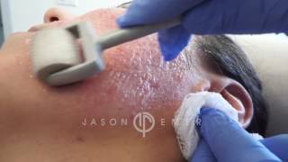 Dermaroller  Microneedling Acne Scars  Skin Resurfacing  Los Angeles California [upl. by Rafi]