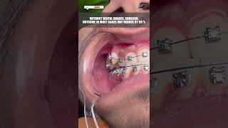 In Cosmetic Jaw Surgery  Why Braces Treatment is a Must orthognathicsurgery cosmeticsurgery [upl. by Ennaul]