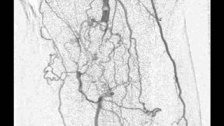 Arteriografia de membros inferiores  CIMI [upl. by Aihseya]