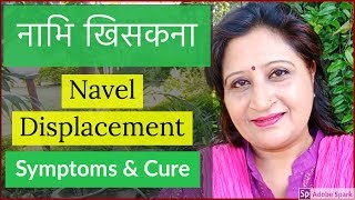 Navel Displacement Treatment  Navel Dislocation  Nabhi Treatment [upl. by Roarke247]