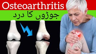 Osteoarthritis in HindiUrdu Symptoms Causes and Treatmentquot ऑस्टियोआर्थराइटिस [upl. by Ettevets]