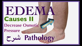 Pathology  Edema causes Decrease Osmotic Pressure  👨🏻‍⚕️ شرح باثو [upl. by Adiana]