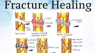 Fracture Healing Pathology [upl. by Littell366]