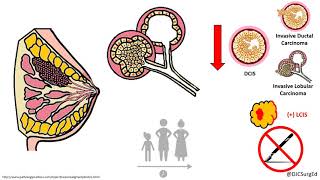 Breast Disease  Risk Lesions Pt 2  DCIS [upl. by Ehcropal407]