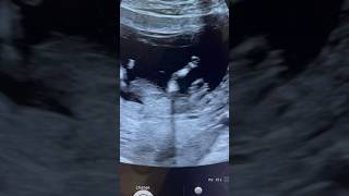 Holoprosencephaly Fetal NT anomaly scan ARDMS Sonography [upl. by Maloney]