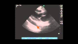 Differentiating pleural vs pericardial effusion by anatomy on echo [upl. by Aikimat]