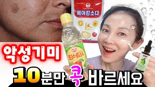 악성기미엔 ✔️베이킹소다에 ✔️식초✔️타마누오일을 섞어서 발라보세요 부글부글 거품이 기미를 녹여요🌟 [upl. by Ray]