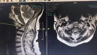 Craniovertebal junction surgery  Success story [upl. by Yllom546]