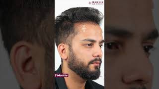 YouTuber Elvish Yadav Before amp After Hair Transplant Results Update After 3 Months [upl. by Ecnerual]