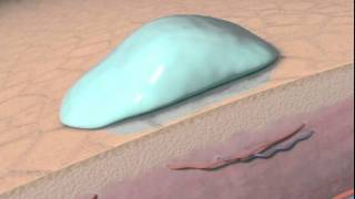 The Science behind Personal Microderm and microdermabrasion with animation [upl. by Jamnis]