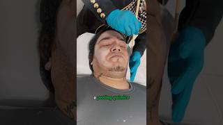 PEELING QUÍMICO ÁCIDO TRICLOROACÉTICO estetica peelingquimico pele shortsvideo [upl. by Nyliak321]