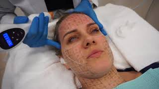 Nonsurgical skin tightening using Thermage CPT by Dr Shaun Patel in Miami FL [upl. by Rillis]