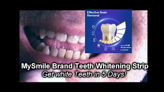 What are the best teeth whitening strips [upl. by Loring]