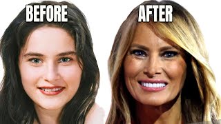 Melania Trumps Plastic Surgery Secrets Exposed 2024 [upl. by Piotr]