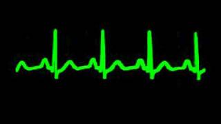 RITMO SINUSAL NORMAL [upl. by Jacobsen]