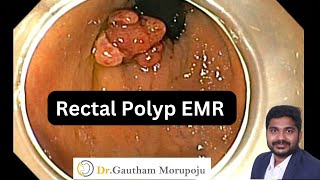 EMR Rectal polyp just above dentate line Dr Gautham Morupoju Best Gastroenterologist [upl. by Hilly]