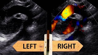 Left vs Right aortic arch how to identify in echocardiography [upl. by Murial]