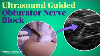 Ultrasound Guided Obturator Nerve Block [upl. by Rice785]