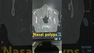 Nasal polyps shortvideo viralshorts nasalpolyps [upl. by Etz936]