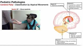 Cerebral Palsy Overview 🧠 Introduction amp Classifications [upl. by Oluas239]