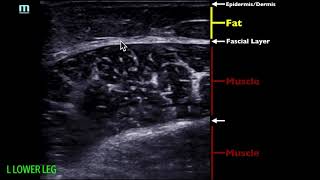 POCUS  Soft Tissue Ultrasound  Soft Tissue Edema [upl. by Natelson3]