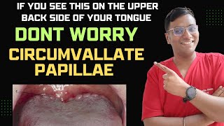 Dr Rudra If you see this on the upper back side of your tongue DONT WORRY Circumvallate Papillae [upl. by Krys]