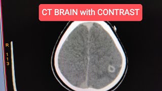 Neurocysticercosis NCC CT Scan Brain with Contrast [upl. by Ebanreb442]