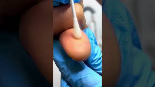 Freezing a Huge Wart with Liquid Nitrogen  Wart Removal Procedure 😬🧊 [upl. by Elbag]