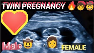 Twin Pregnancy💕l Monochorionic and Monoamniotic twin🔥l [upl. by Aihsoem]