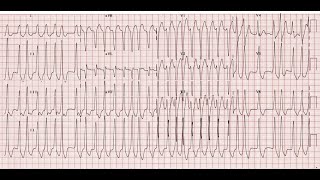 EKG 101  Clinical Cases  StepbyStep Tutorial  Part 77 [upl. by Akcirahs]