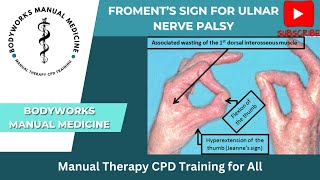 Froments Sign for Ulnar Nerve Palsy [upl. by Akeirahs696]